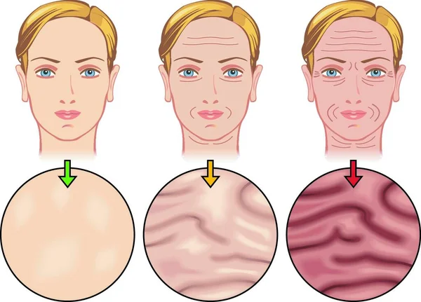 Medizinische Illustration Der Auswirkungen Der Hautalterung — Stockvektor