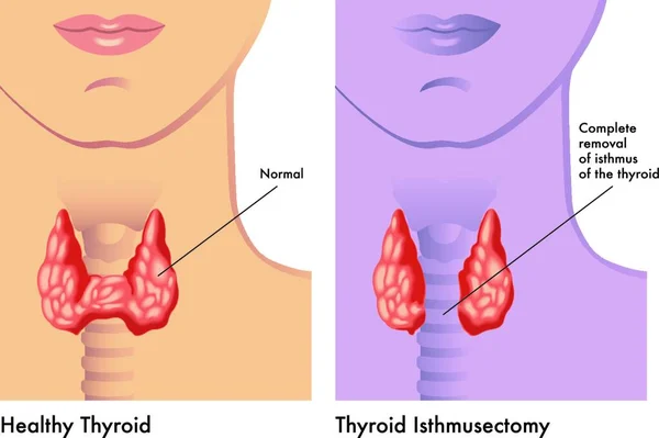 Illustration Médicale Simple Une Opération Isthmusectomie Thyroïdienne — Image vectorielle