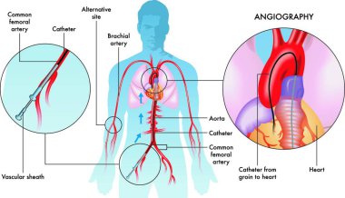 Labelled illustration of coronary angiography operations on adult male, white background. clipart