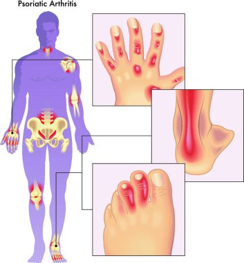 Illustration of human body showing close up of anatomy effected by psoriatic arthritis. clipart