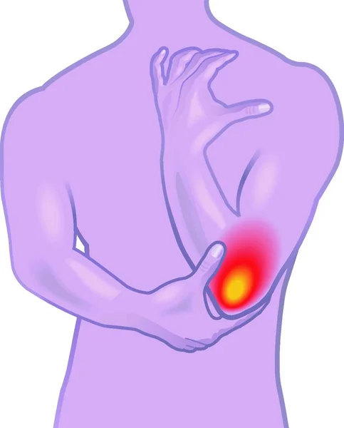 肘部疼痛或网球肘部症状的医学说明 也被称为震中炎 — 图库矢量图片