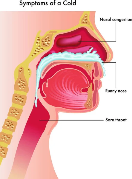 Una Ilustración Médica Del Tracto Respiratorio Superior Una Persona Con — Vector de stock