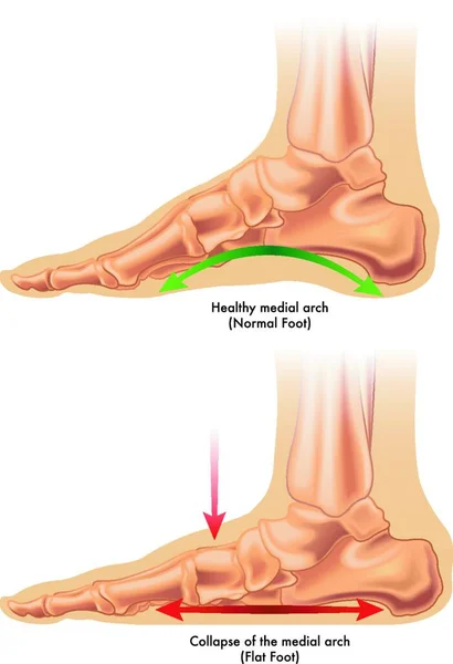 Medizinische Illustration Der Folgen Eines Plattfußes — Stockvektor