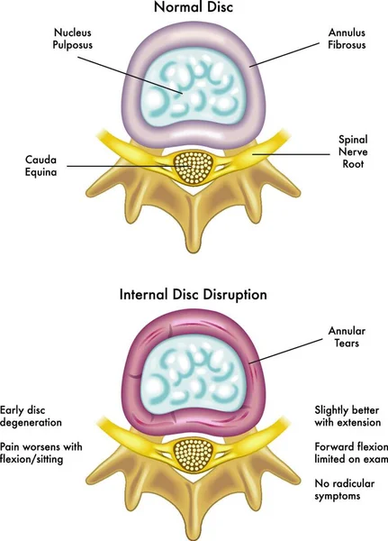 Ilustrație Medicală Efectelor Discului Perturbare Internă — Vector de stoc