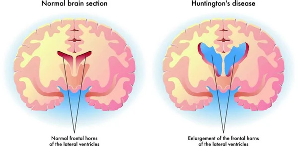 Ilustração Médica Dos Sintomas Doença Huntington Cérebro — Vetor de Stock