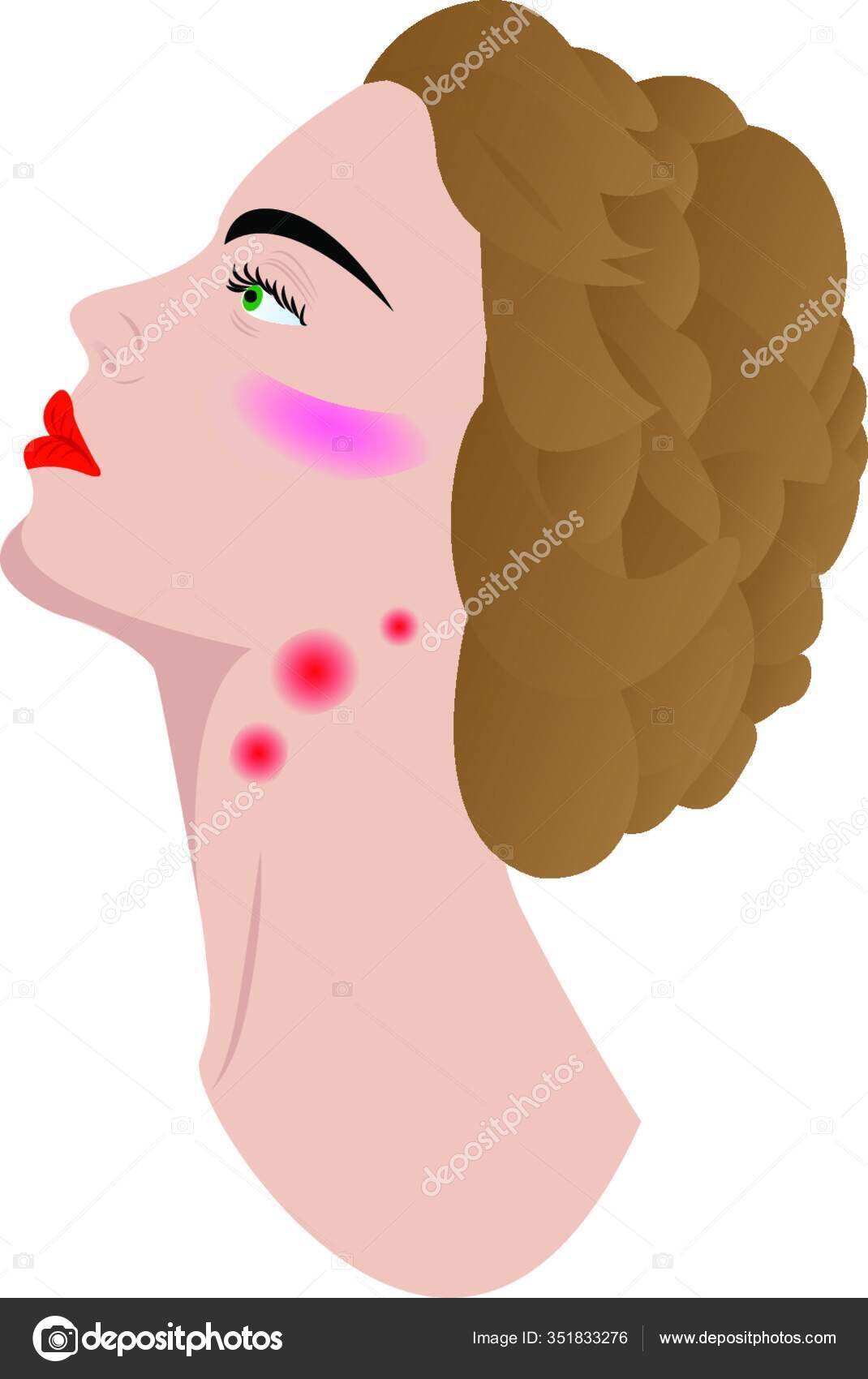 Image vectorielle Gonflement Des Ganglions Lymphatiques Maladie Dans Cou Femme Adénopathie
