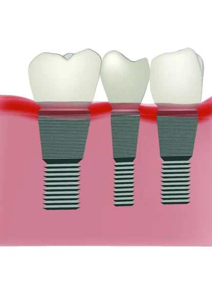 Tandprothese Tandheelkundige Praktijk Implantaat — Stockvector