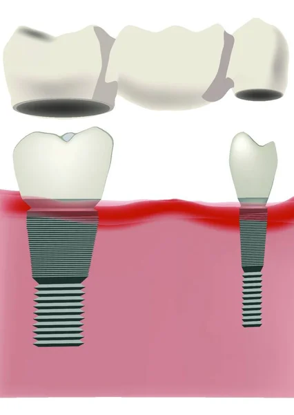 Prótese Dentária Implante Prática Odontológica — Vetor de Stock