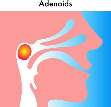 medical illustration of the adenoids clipart