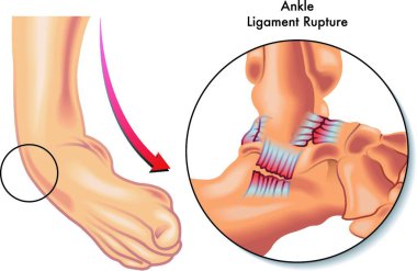 medical Illustration of ankle ligament rupture clipart