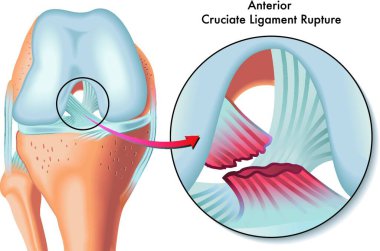 medical Illustration of anterior cruciate ligament rupture clipart