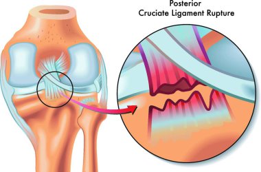 medical Illustration of posterior cruciate ligament ruptur clipart