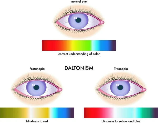 Illustration Médicale Des Symptômes Daltonisme — Image vectorielle