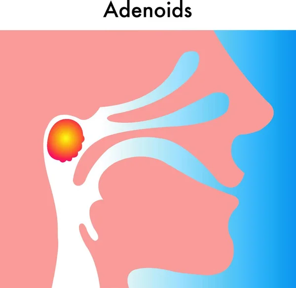 Illustrazione Medica Degli Adenoidi — Vettoriale Stock