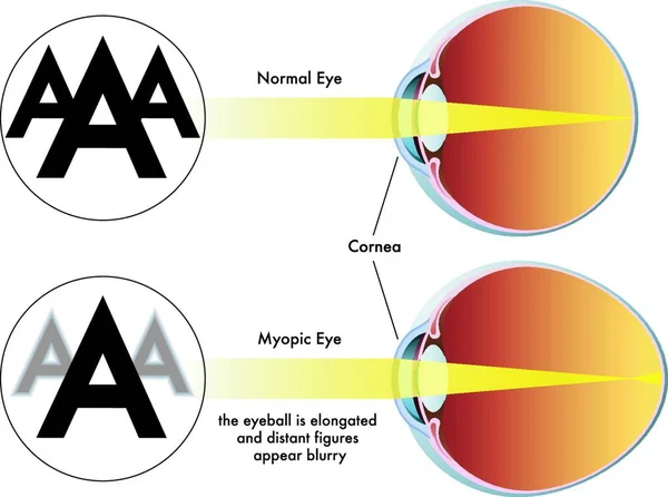 Medical Illustration Symptoms Myopia — Stock Vector