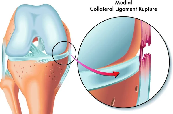 Ilustración Médica Rotura Del Ligamento Colateral Medial — Archivo Imágenes Vectoriales