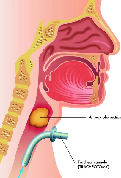 Medische Illustratie Van Een Tracheotomie — Stockvector