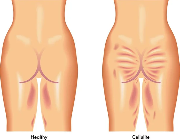 Ilustração Médica Dos Sintomas Celulite — Vetor de Stock