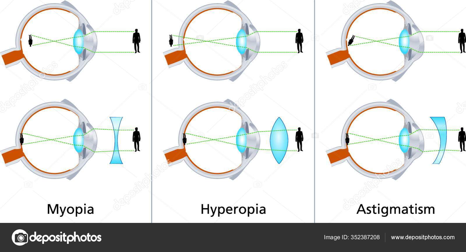 astigmatism miopic vizual
