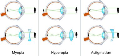 Illustration of the three visual defects Myopia, Hyperopia and Astigmatism and how to correct it with biconcave and biconvex lenses - with glasses or contact lenses. clipart