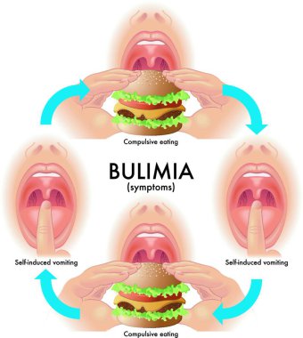 medical illustration of the symptoms of bulimia clipart