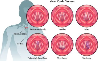 medical illustration of the vocal cord diseases clipart
