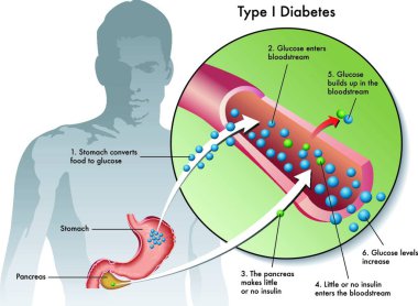 medical illustration of the symptoms of type 1 diabetes clipart