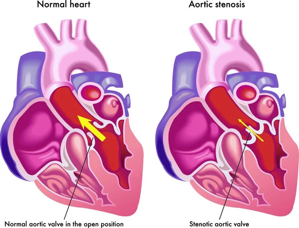Medizinische Illustration Der Symptome Der Aortenstenose — Stockvektor