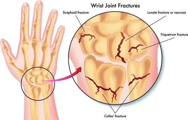 Illustration Médicale Des Différents Types Fractures Poignet — Image vectorielle