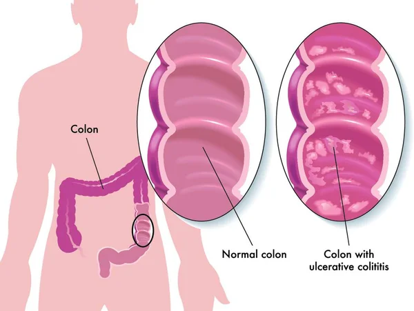 Ilustração Médica Dos Sintomas Colite Ulcerativa —  Vetores de Stock