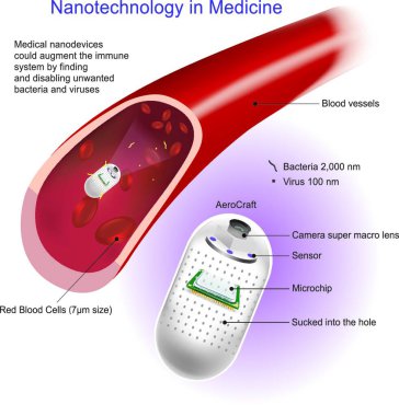 Angioplasty (or Balloon angioplasty) is an endovascular procedure to widen narrowed or obstructed arteries or veins, typically to treat arterial atherosclerosis clipart