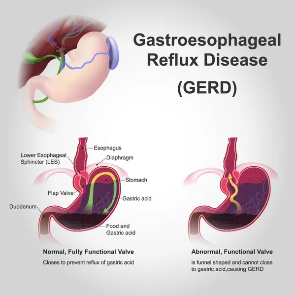 Gastroesophageal Reflux Disease Gerd Також Відомий Рефлюкс Кислоти Довгостроковий Стан — стоковий вектор