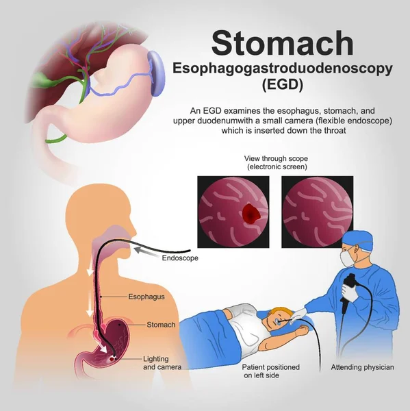 Esophagogastroduodenoscopy Más Néven Különböző Más Nevek Egy Diagnosztikai Endoszkópos Eljárás — Stock Vector