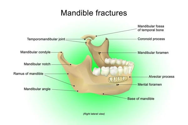 Mandible Fractures Largest Strongest Lowest Bone Face Vector Design Arts — Stock Vector