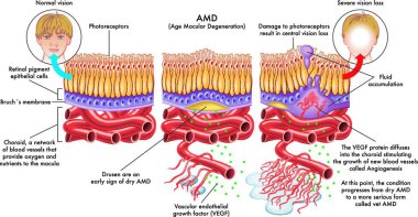 Medical illustration of the symptoms of age macular degeneration clipart