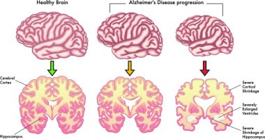 medical vector illustration of alzheimer's disease progression clipart
