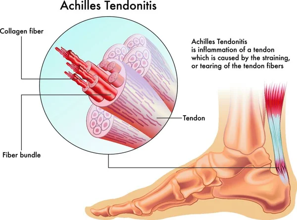 Gambaran Vektor Medis Dari Gejala Tendonitis Ashilles - Stok Vektor