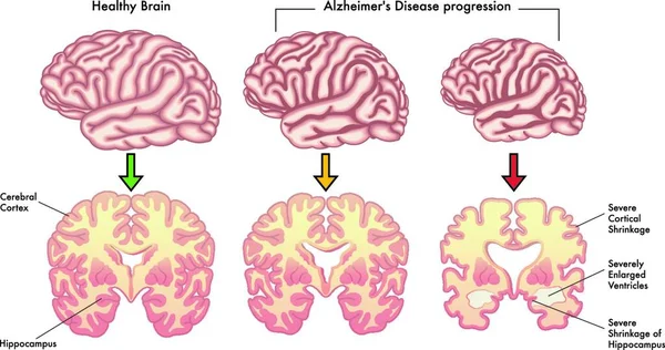 Illustration Vectorielle Médicale Progression Maladie Alzheimer — Image vectorielle