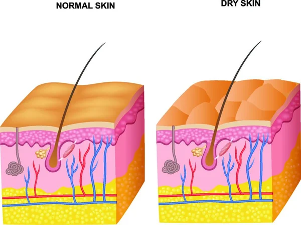Εικονογράφηση Των Στρωμάτων Κανονικό Δέρμα Και Ξηρό Δέρμα — Διανυσματικό Αρχείο