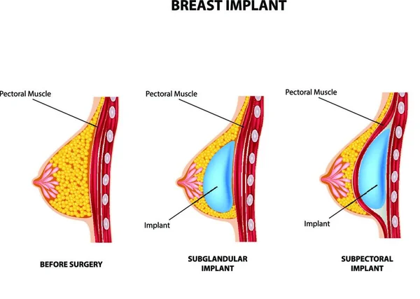 Ilustración Cirugía Plástica Del Implante Mamario — Vector de stock