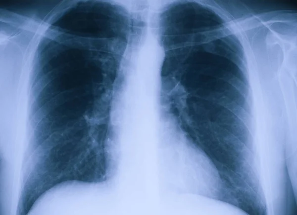 Frontális Röntgenkép Két Tüdőszárnyról — Stock Fotó