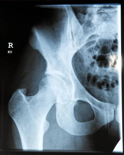 Csípő Röntgenképe — Stock Fotó