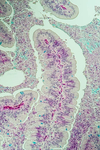 Diagnostic Ver Aveugle Transcendantal Intestinal — Photo