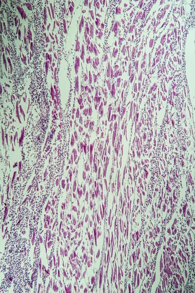 Inflammation Muscle Cardiaque 100X — Photo