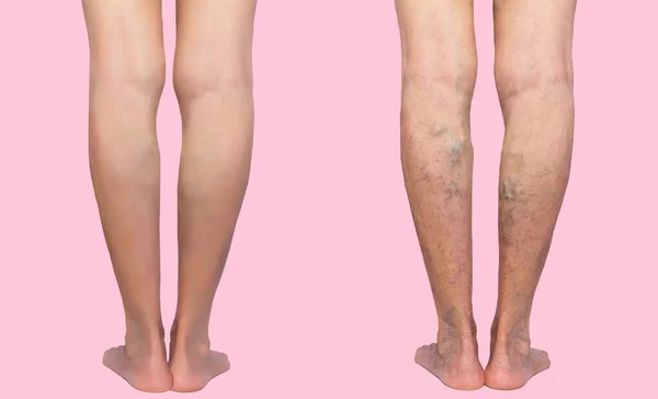 Treatment Varicose Varicose Veins Senior Female Legs — Stock Photo, Image