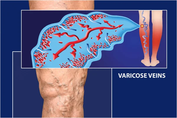 Öregség Beteg Visszerek Egy Lábán Varikozitás Pók Vénák Ödéma Betegség — Stock Fotó