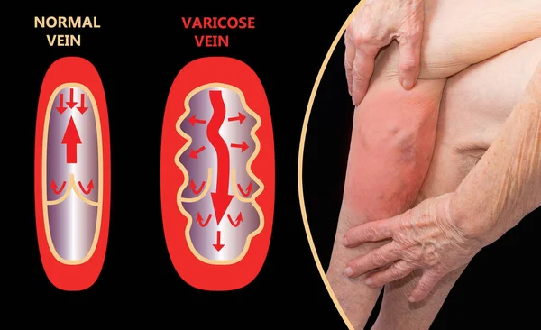 Varicose Veins Female Senior Leg Collage Structure Normal Varicose Veins — Stock Photo, Image