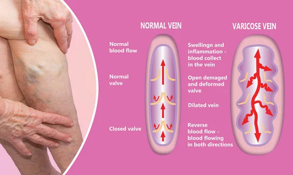 Varicose veins on a female senior legs. The structure of normal and varicose veins. Concept of dry skin, old senior people, varicose veins and deep vein thrombosis or DVT