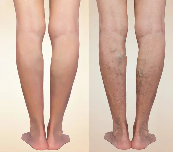 Treatment of varicose before and after. Varicose veins on the senior female legs.