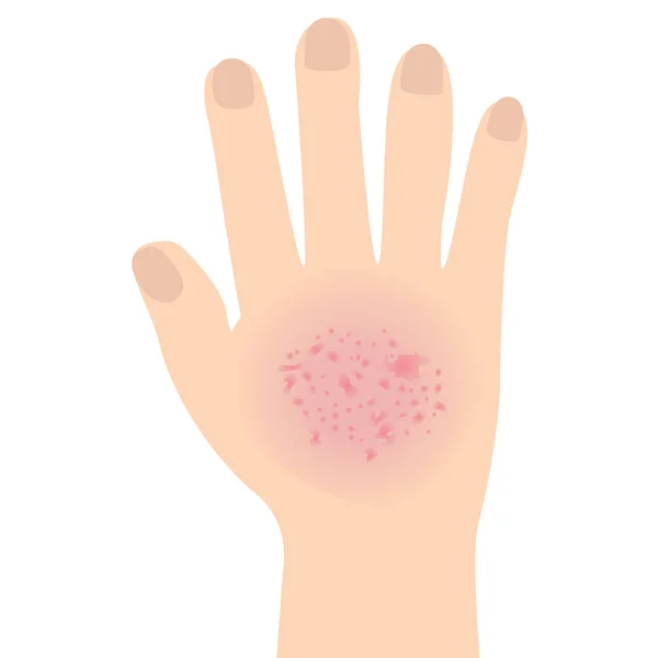 湿疹は 白い背景に単離された手の皮膚疾患の概念ベクターイラストに影響を与えた — ストック写真